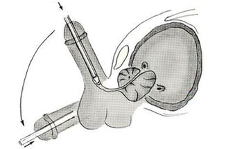 Endoscopic penis enlargement surgery options
