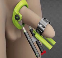 Surgery increases rehabilitation after penis