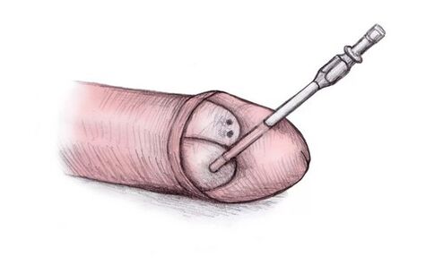 The head of the penis can be enlarged by injecting hyaluronic acid